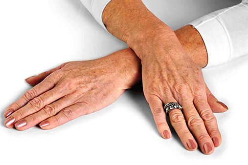 Skin of the hands with age-related changes that require the use of rejuvenation techniques