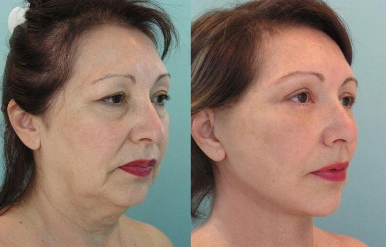 The result of facial skin rejuvenation firming with threads
