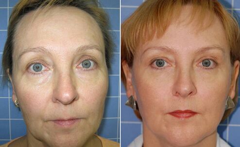Before and after facelift with fractional laser