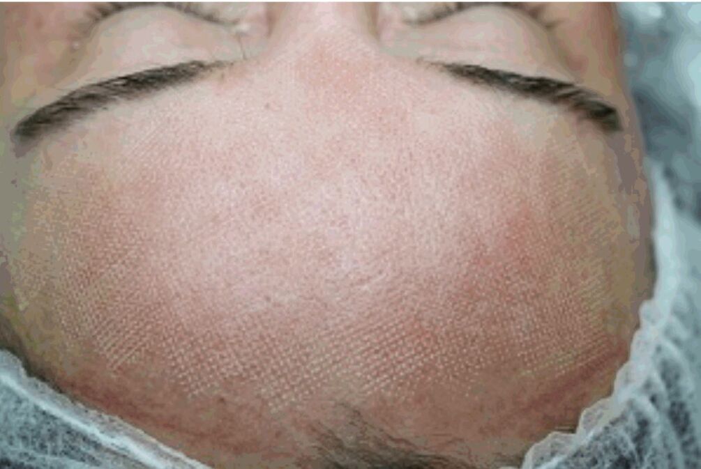 Redness and slight swelling of the skin after the fractional laser