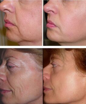 photos before and after fractional laser rejuvenation